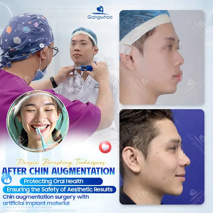 When Can You Brush Your Teeth After Chin Augmentation? A Safe Oral Care Guide