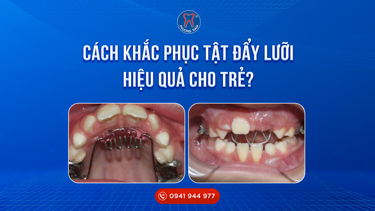 Cách khắc phục tật đẩy lưỡi hiệu quả ở trẻ mà bạn nên biết