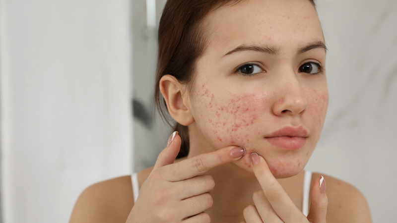 Dùng sữa rửa mặt La Roche Posay giả có thể gây kích ứng da