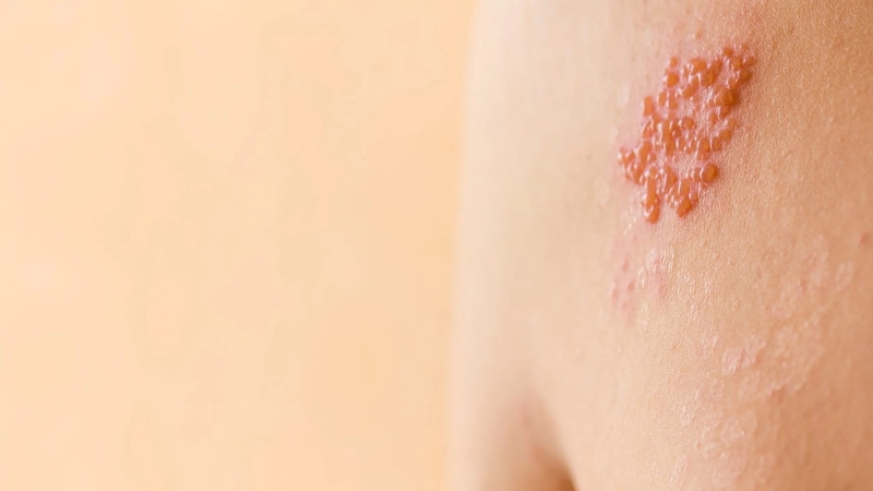 Ghẻ phỏng là bệnh gì? Có chữa được không?