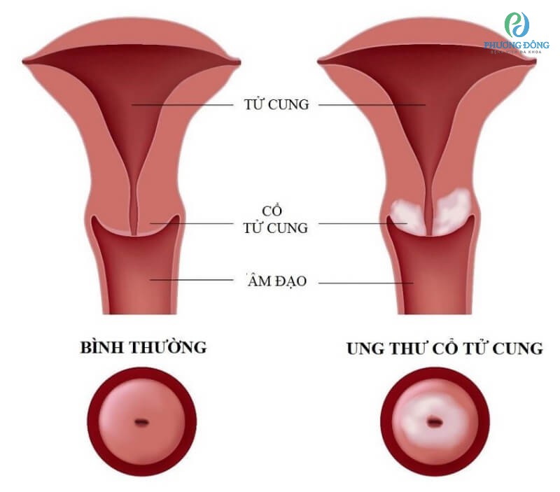 Hiện tượng ra khí hư màu hồng có thể là bệnh lý ung thư cổ tử cung