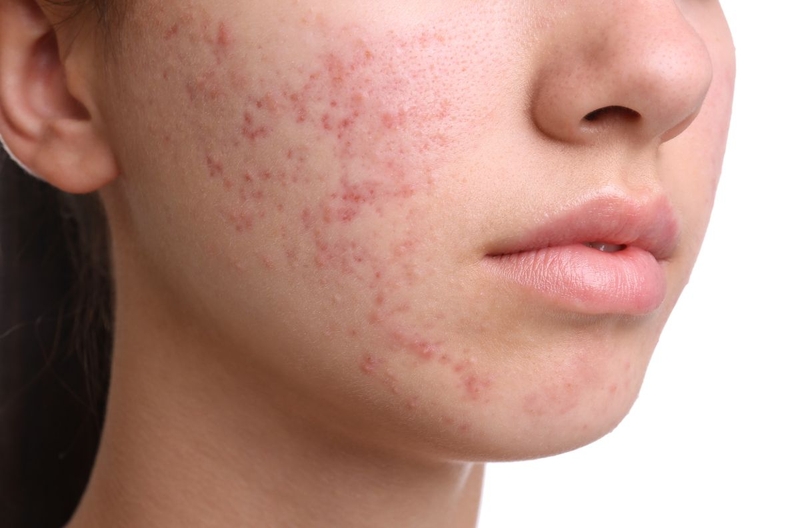 Trẻ 14 tuổi có nên dùng sữa rửa mặt không? Kinh nghiệm chọn sữa rửa mặt phù hợp
