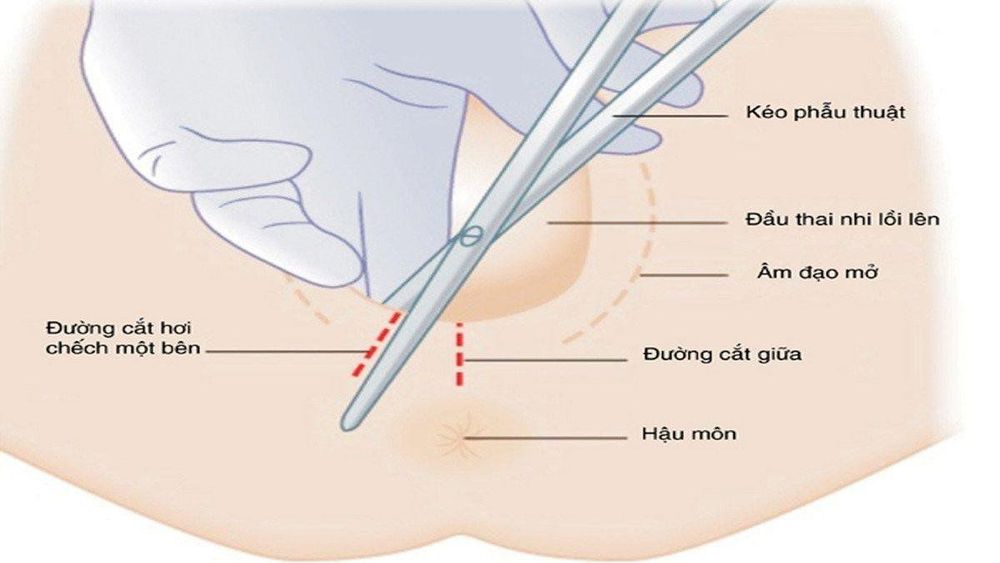 Gây tê thần kinh thẹn: Sản phụ trải nghiệm “đẻ không đau” khi sinh tại Vinmec Phú Quốc