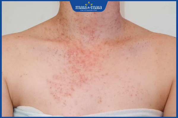 Triệt lông 1 tuần mấy lần? Mỗi lần triệt cách nhau bao lâu?