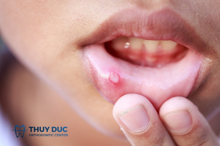 7. Lợi ích của việc sử dụng thuốc Oracortia 1