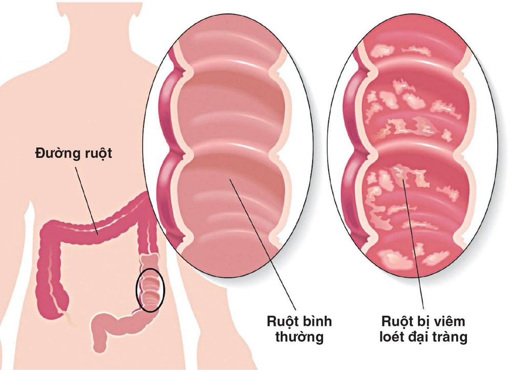 Dấu hiệu đau tức hạ sườn phải cũng gặp ở bệnh viêm loét đại tràng.