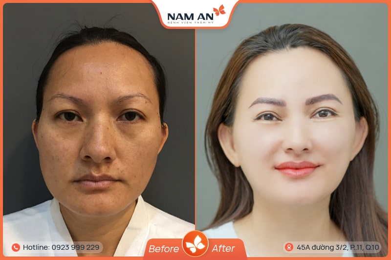 hình ảnh sau khi độn thái dương
