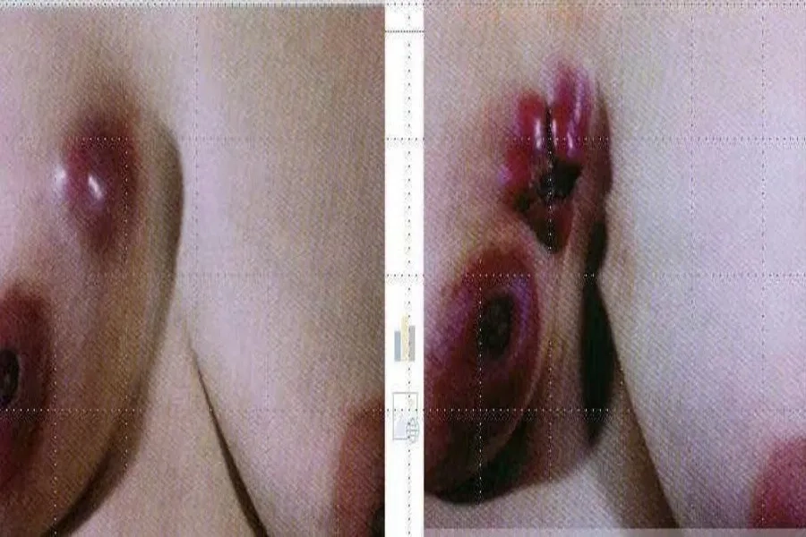 Khối u hoặc thay đổi kích thước vùng ngực so với bên còn lại có thể là biểu hiện của ung thư vú