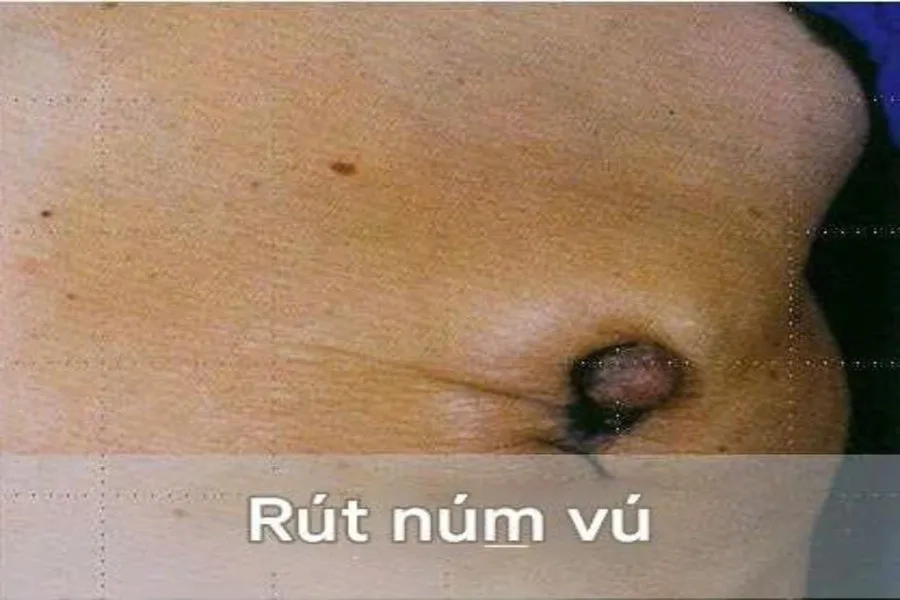 Núm vú lõm vào trong, vùng da bên cạnh nhăn nheo có thể là triệu chứng của ung thư vú