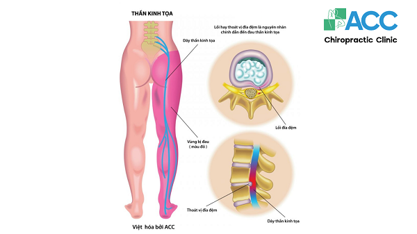 Đau thần kinh tọa là gì? Dấu hiệu, nguyên nhân và điều trị