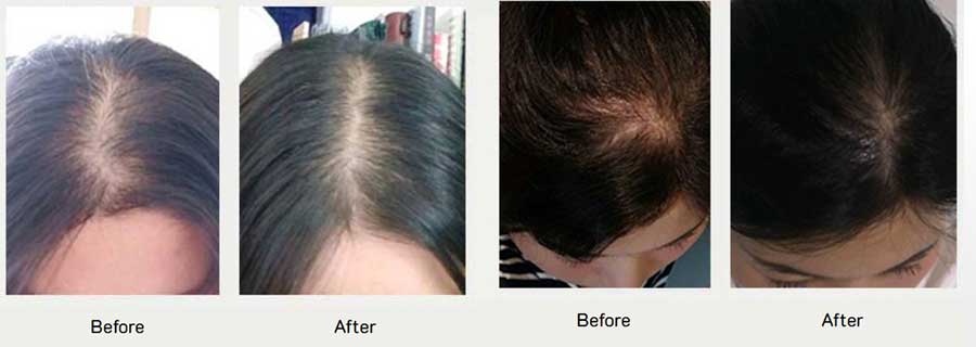 Dầu gội Weilaiya before after