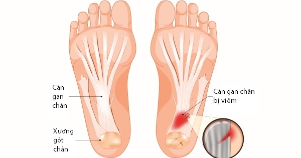 Đau lòng bàn chân: Nguyên nhân, vị trí và cách khắc phục
