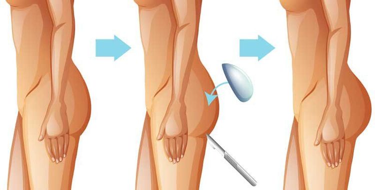 Nâng mông bằng túi độn và những điều cần biết