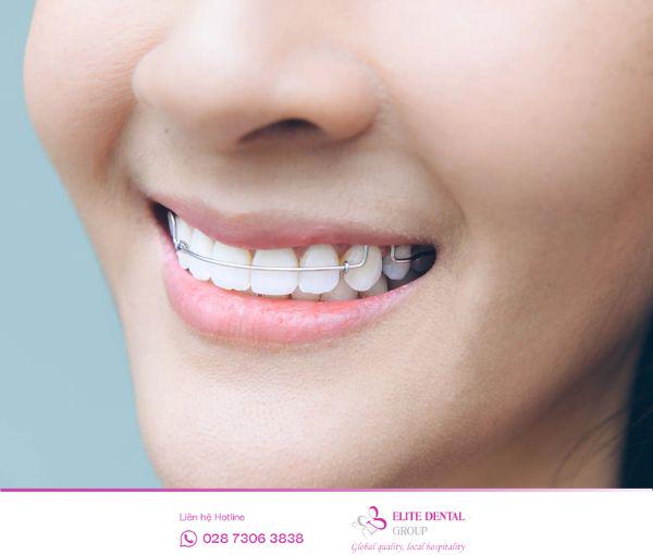 Hàm duy trì tháo lắp bằng kim loại giúp khách hàng ăn uống và vệ sinh răng miệng thuận tiện.