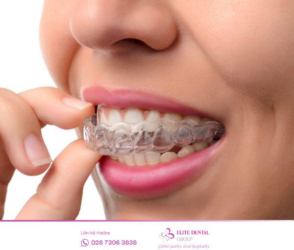 Nên đeo hàm duy trì đúng thời gian chỉ định