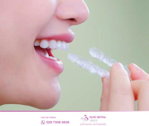 Hàm duy trì là gì? Vì sao nên đeo hàm duy trì sau niềng răng?