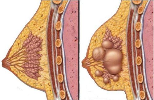 Các biện pháp chẩn đoán hình ảnh đánh giá khối u vú