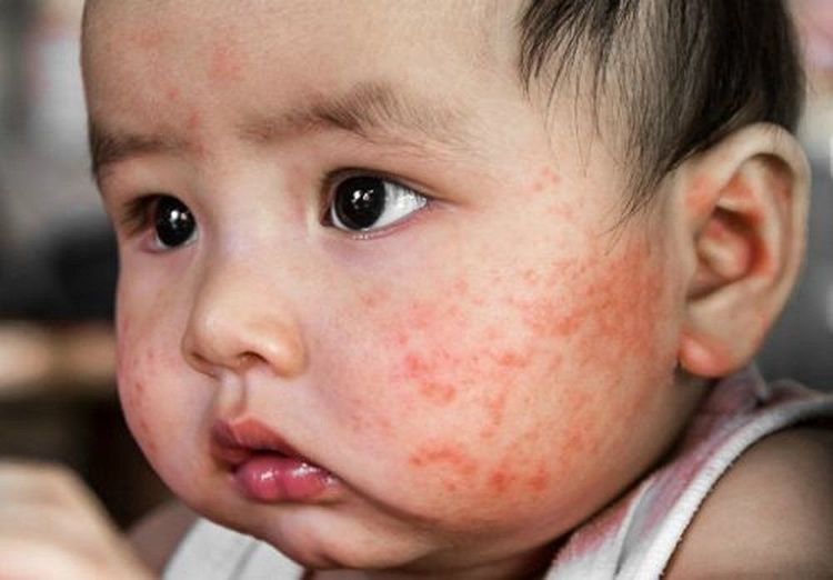 Có nên dùng kem dưỡng ẩm cho trẻ sơ sinh?