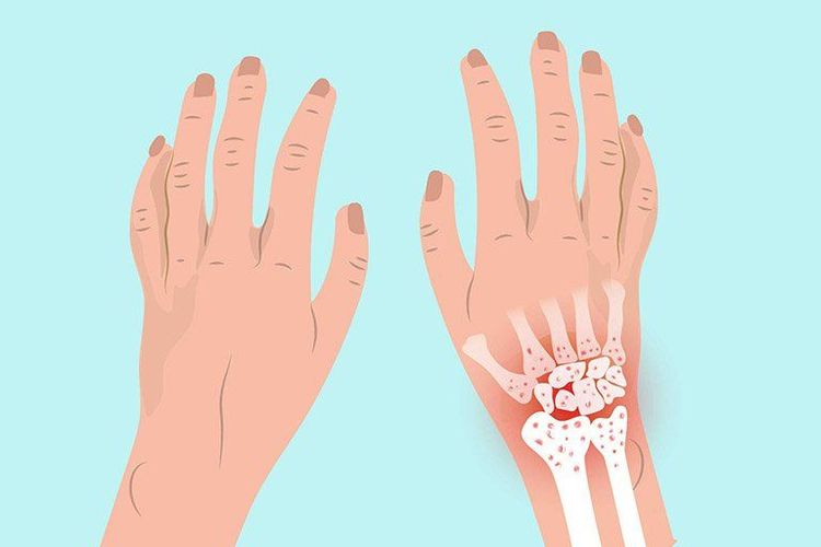 Lắng đọng canxi ở khớp gây đau nhức