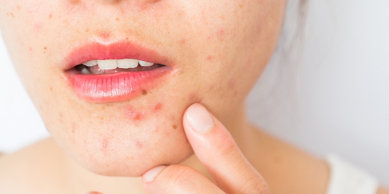 Mủ là gì? Nguyên nhân và triệu chứng của tình trạng mưng mủ 4