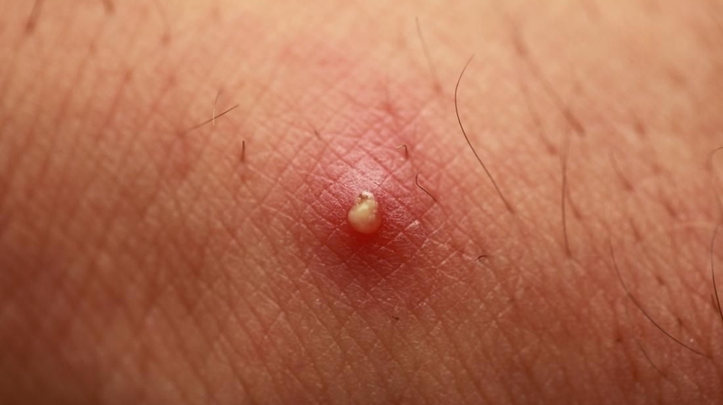 Mủ là gì? Nguyên nhân và triệu chứng của tình trạng mưng mủ