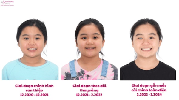 tiền chỉnh nha cho trẻ em