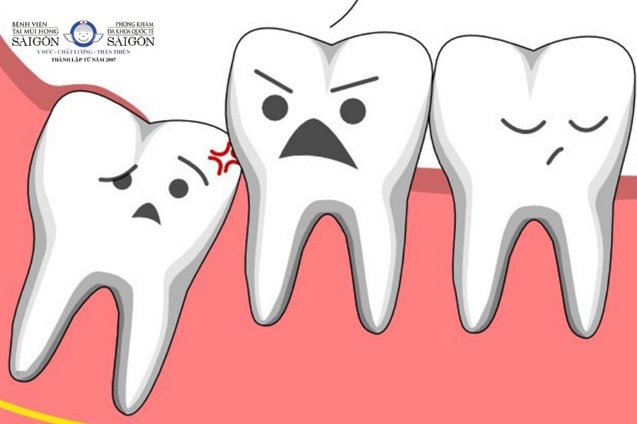 Mọc răng khôn bị đau vì sao? 14 cách giảm đau nhanh hiệu quả