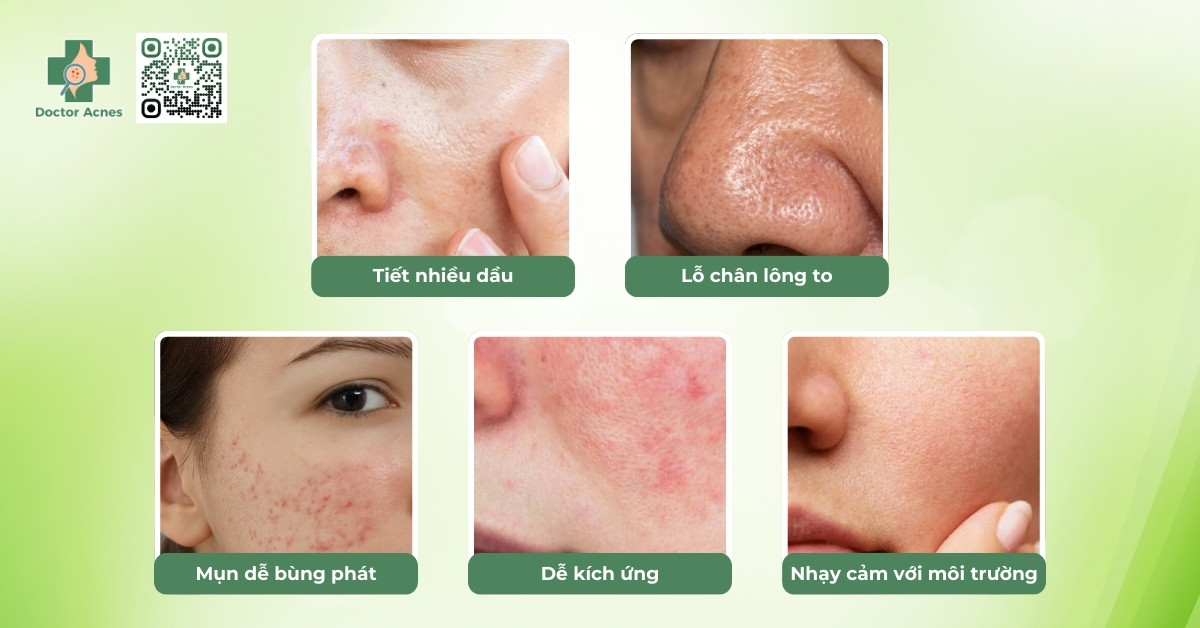 Top 13 sữa rửa mặt phù hợp cho da dầu mụn nhạy cảm