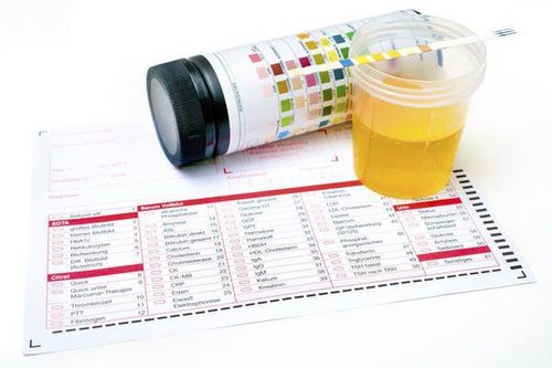 Ý nghĩa chỉ số SG trong xét nghiệm nước tiểu