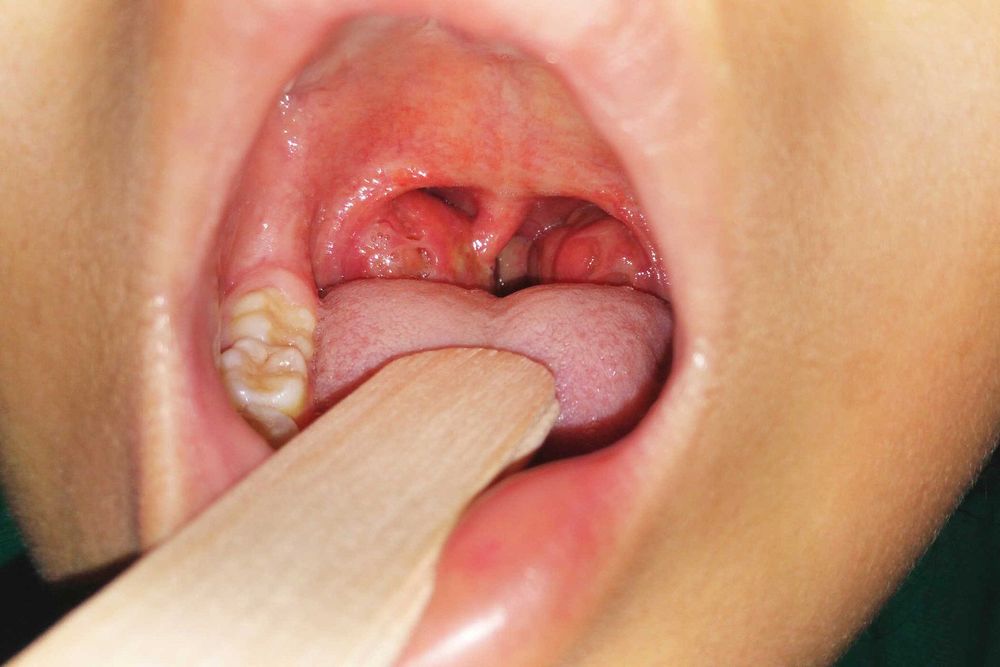 Khối amidan vùng hầu họng bị viêm nhiễm lâu ngày trở nên phì đại