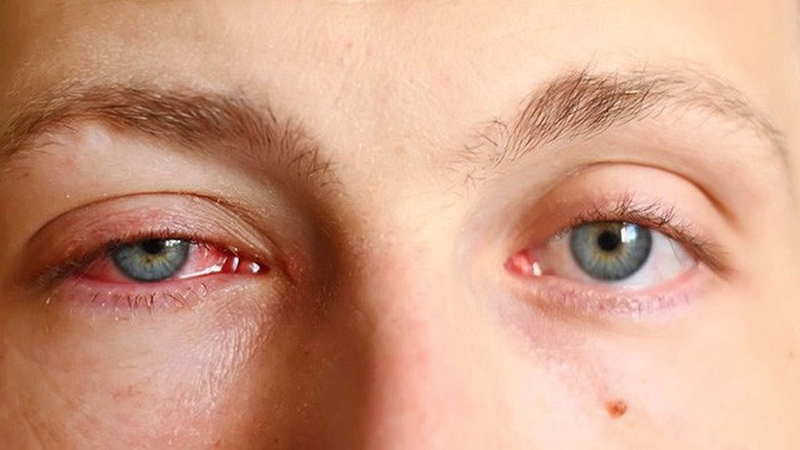 Lông xiêu là gì? Nguyên nhân và cách điều trị 3