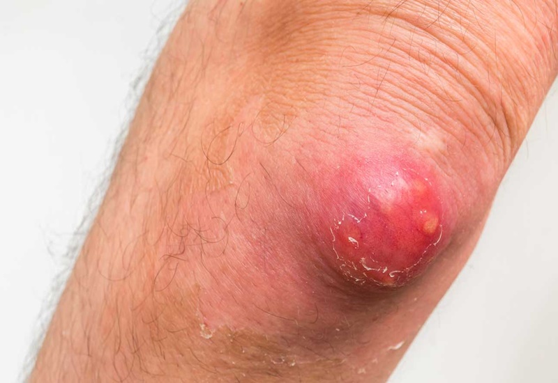 Bệnh hậu bối do vi khuẩn gây ra