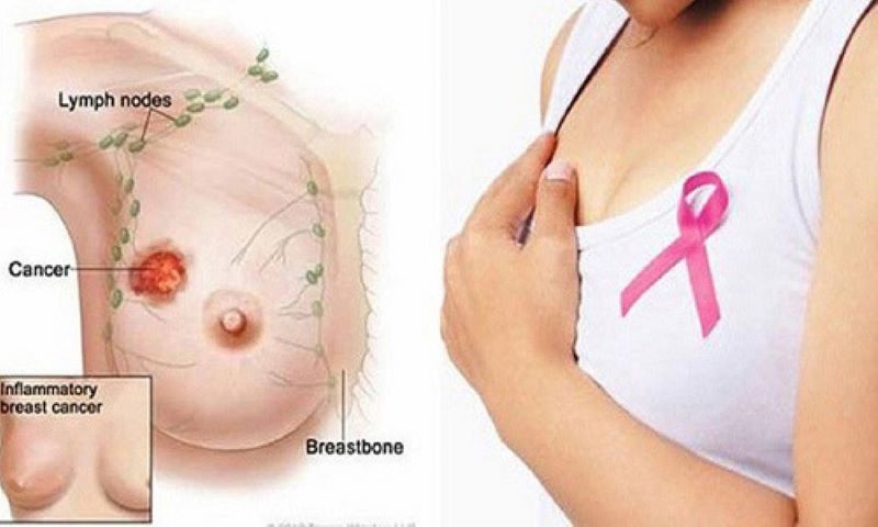 Tuy là căn bệnh nguy hiểm nhưng ung thư vú có thể điều trị khỏi nếu được phát hiện sớm và điều trị đúng cách