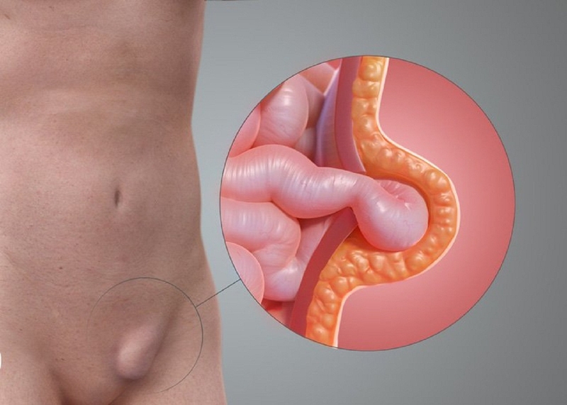 Tinh hoàn lạc chỗ là gì? Nguyên nhân, triệu chứng và cách điều trị