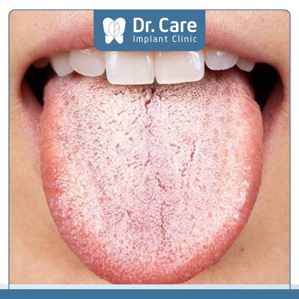 Dấu hiệu dễ thấy khi nhiễm trùng nấm miệng là lưỡi nổi nhiều hạt trắng 