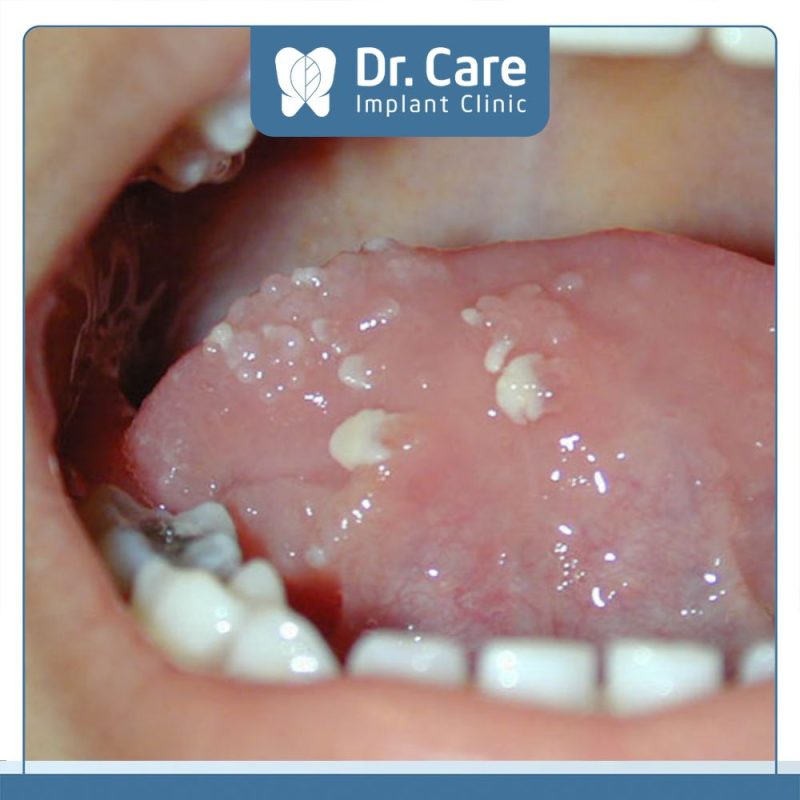 Lưỡi nổi hạt trắng là gì? Dấu hiệu, nguyên nhân và cách điều trị