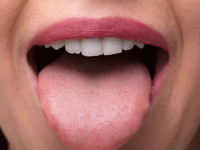 Đầu lưỡi nổi hột đỏ: Nguyên nhân và dấu hiệu nhận biết bệnh lý 3