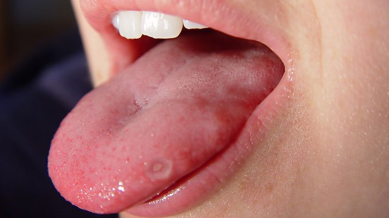 Đầu lưỡi nổi hột đỏ: Nguyên nhân và dấu hiệu nhận biết bệnh lý