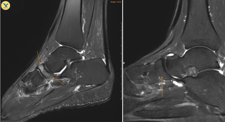 Hình ảnh MRI cho thấy xương ghe ở bệnh nhân mắc Hội chứng Müller-Weiss (bên trái) có vùng sáng hơn bất thường, trong khi xương ghe ở bàn chân bình thường (bên phải) có hình ảnh đồng nhất hơn