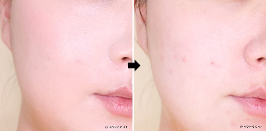 Gel Rửa Mặt Bioderma Ngăn Ngừa Mụn Cho Da Dầu Sebium Gel Moussant