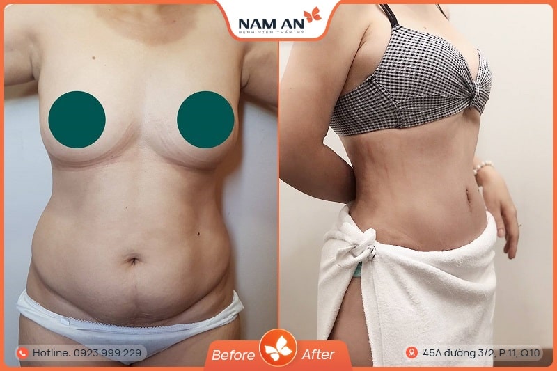 hình ảnh sau khi cắt da thành bụng