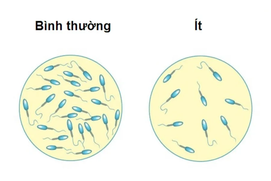 ICSI áp dụng cho trường hợp người chồng có chất lượng tinh trùng kém