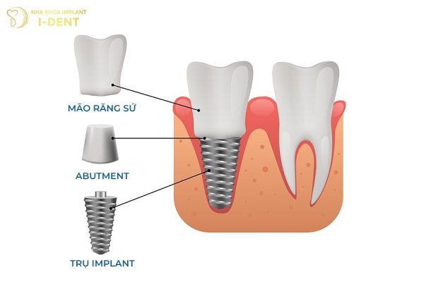 Cấu tạo răng Implant gồm những gì?