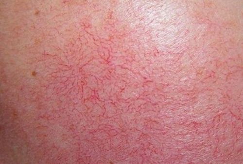 Hình ảnh giãn mạch máu ở da do nhiễm corticoid