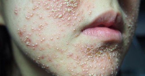 Dấu hiệu da nhiễm corticoid