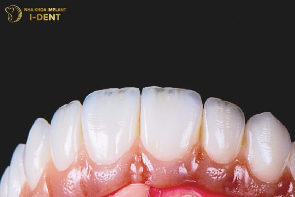 Mão Răng Sứ Là Gì? Bọc Mão Răng Sứ Giá Bao Nhiêu?