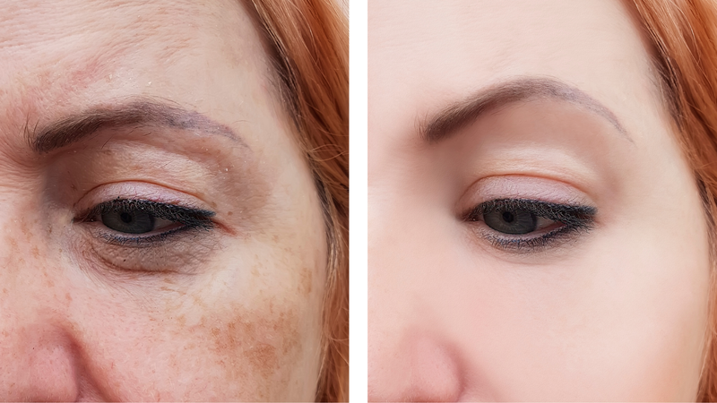 Mesotherapy là gì? Chỉ định và chống chỉ định thực hiện cần biết 2