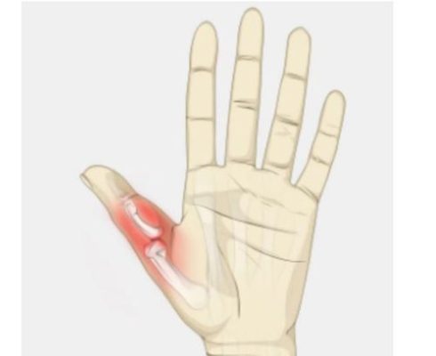 Đau khớp ngón tay cái: Nguyên nhân và phương pháp điều trị hiệu quả