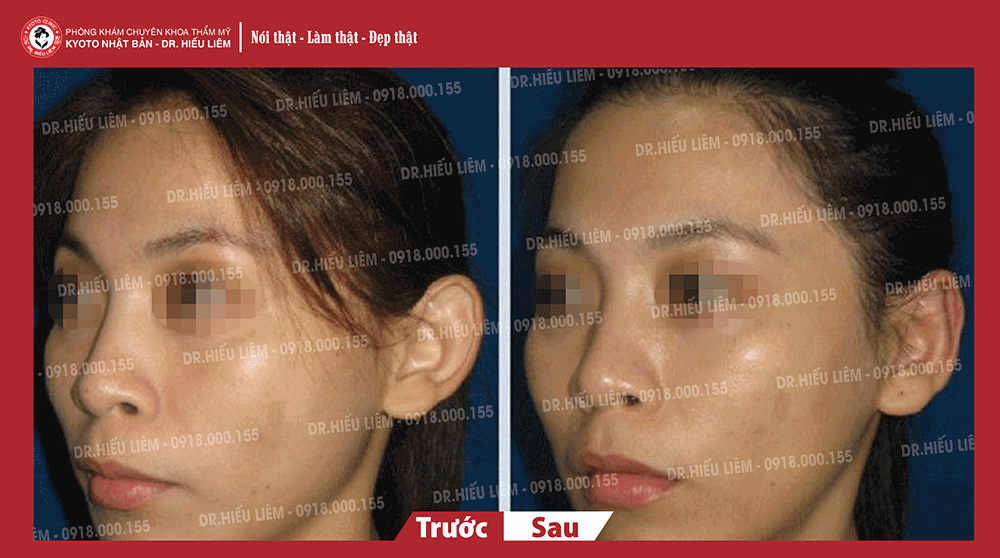 Hình ảnh khách hàng chỉnh hình tai vểnh tại quận 10 tphcm