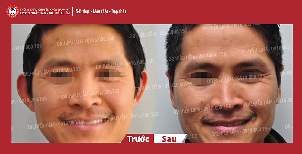 Chỉnh hình tai vểnh như thế nào